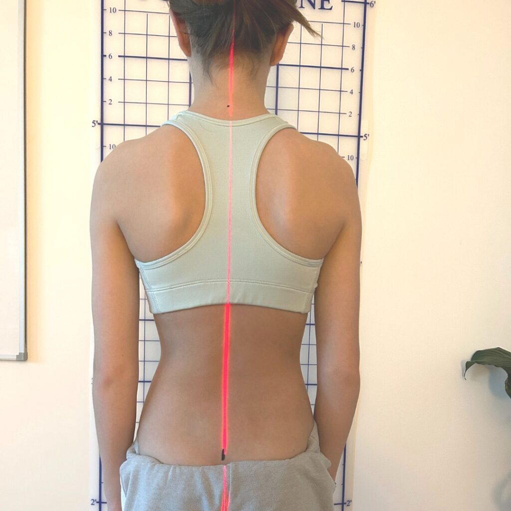 Torso Re Shaping With Scoliosis Specific Exercises And Custom Bracing