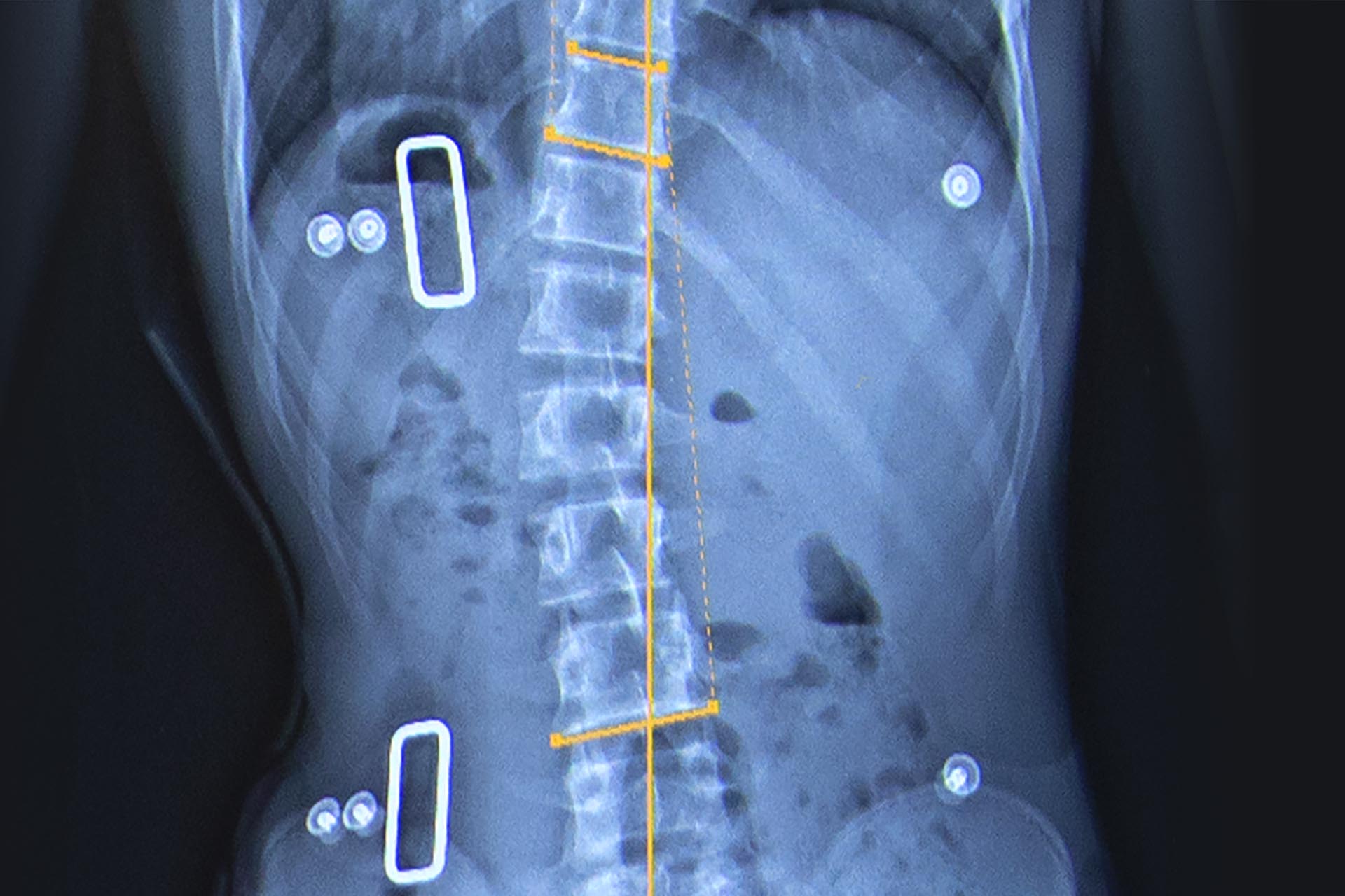 Low-Dose X-Rays | National Scoliosis Center