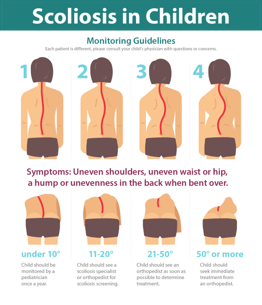 Scoliosis, Kyphosis and SMA National Scoliosis Center