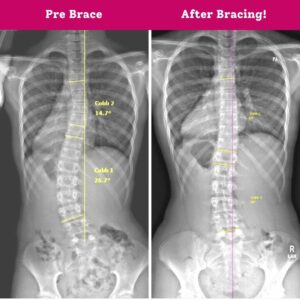 Kate's before and after bracing X-rays for scoliosis