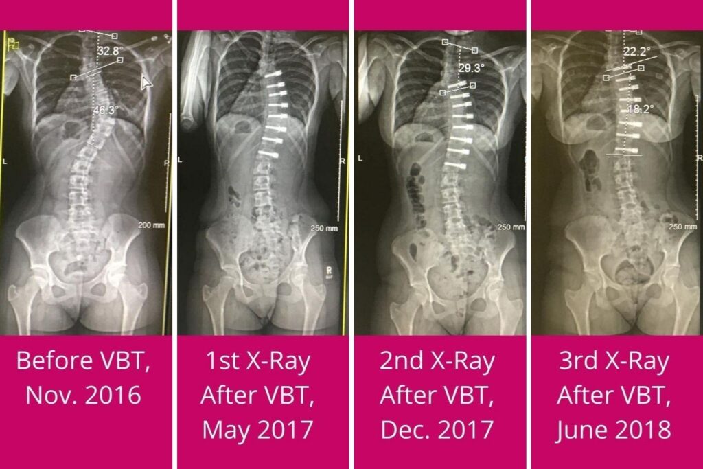 Pre and Post VBT X-Rays