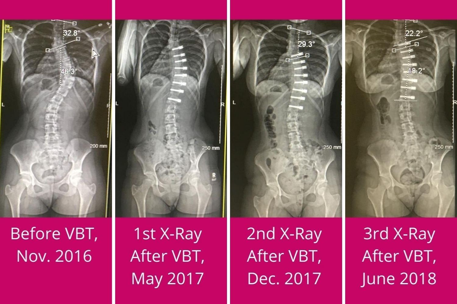 Vertebral Body Tethering A Sound Surgical Option To Treat Severe Scoliosis National Scoliosis