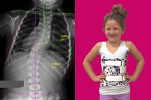 scoliosis