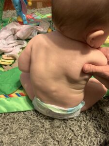 baby with scoliosis