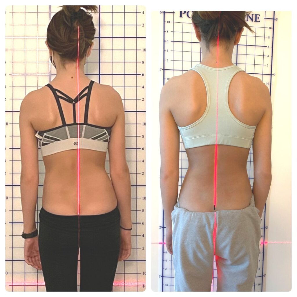 scoliosis brace before and after