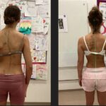 girl's back before and after scoliosis bracing