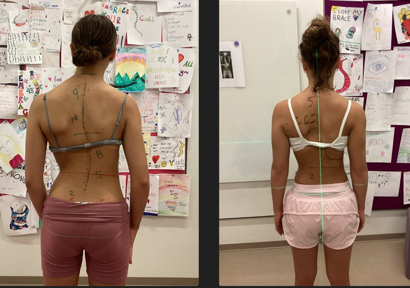 girl's back before and after scoliosis bracing