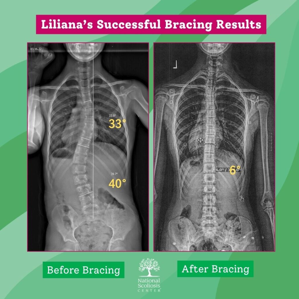 Scoliosis Bracing X-Ray Results