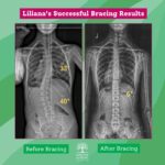 Scoliosis Bracing X-Ray Results